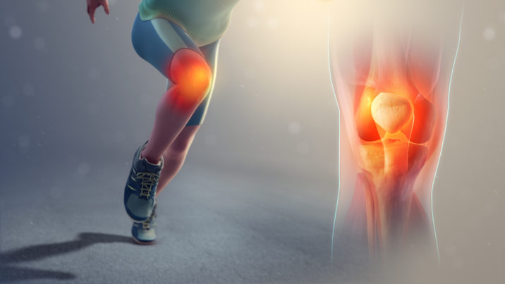 artroză a genunchiului în 4 stadii de tratament dureri la nivelul genunchiului umflături sub genunchi